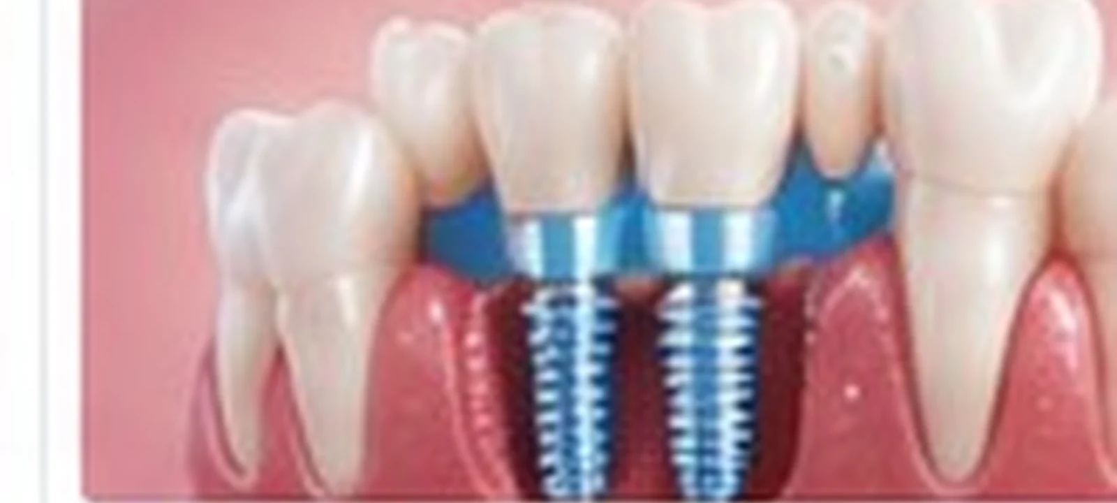 All On 4 Dental Implants medical care in India